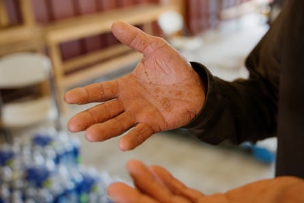 Detail image of dry hands